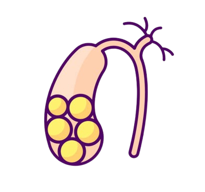 gallstone