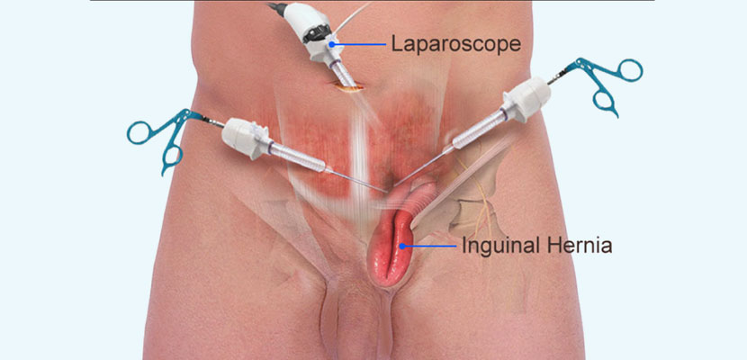 open Inguinal hernia