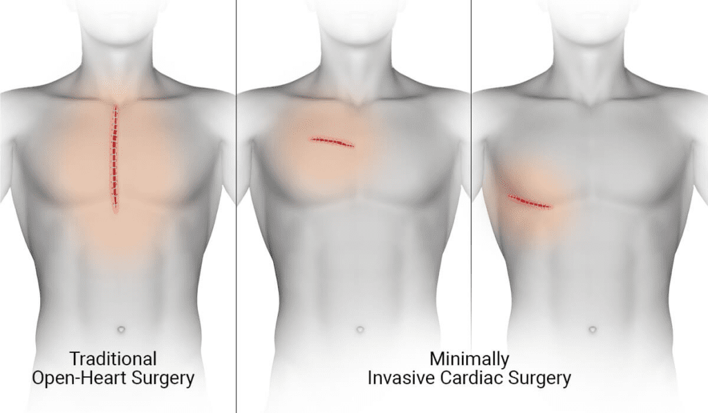 Minimally Invasive Cardiovascular Surgery (MICS)
