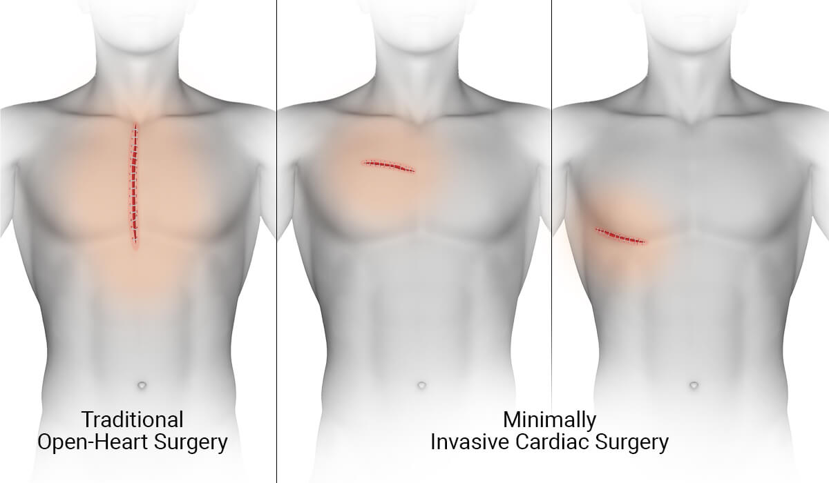 Minimally Invasive Cardiovascular Surgery (MICS) in hyderabad