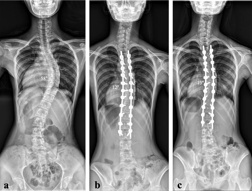 scoliosis surgery in Hyderabad