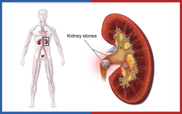 Kidney Stone Surgery in Hyderabad