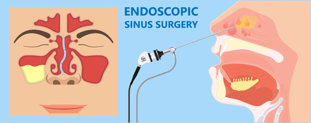 FESS Surgery in hyderabad