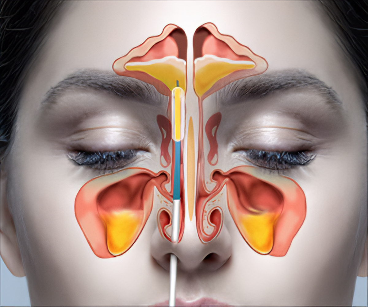 sinus surgery in hyderabad