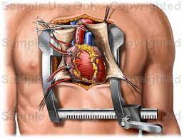 Open Heart Surgery in hyderabad