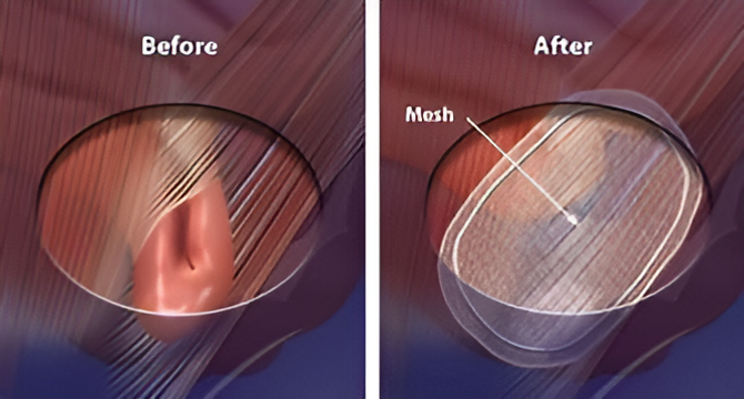 hernia surgery result