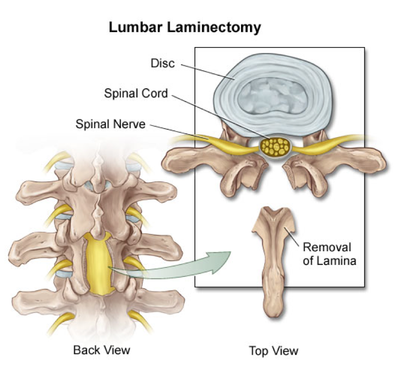 Laminectomy Surgery 