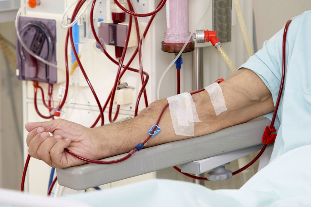 Dialysis procedure in Hyderabad