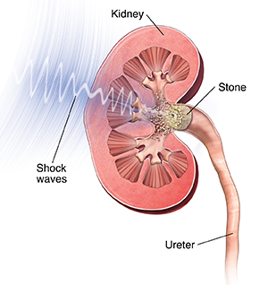 Lithotripsy Treatment in Hyderabad