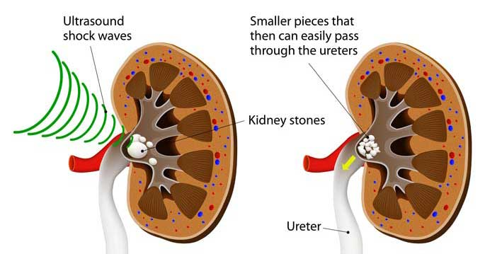 Lithotripsy Treatment in Hyderabad