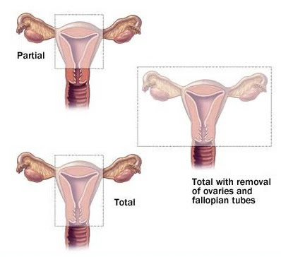 Hysterectomy Surgery