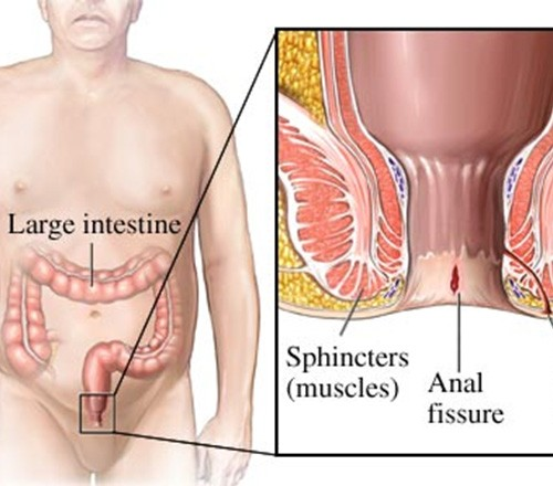 Anal Fissure Surgery