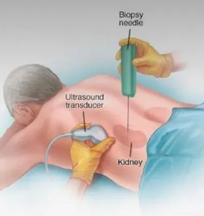 Kidney Biopsy in Hyderabad