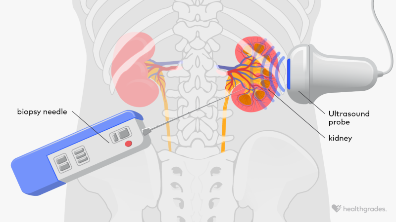 Kidney Biopsy