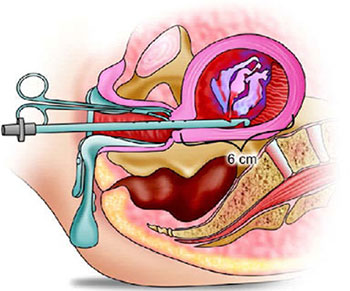 Medical Termination of Pregnancy (MTP) surgery in Hyderabad