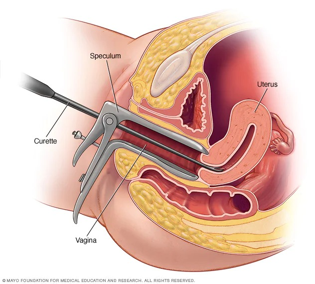 Medical Termination of Pregnancy (MTP) surgery
