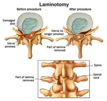 Laminectomy Surgery in Hyderabad
