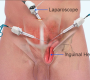 open Inguinal hernia