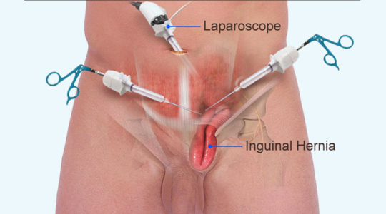 open Inguinal hernia