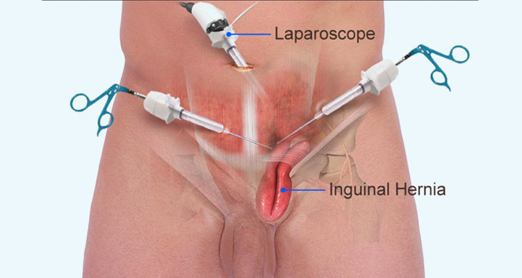 open Inguinal hernia