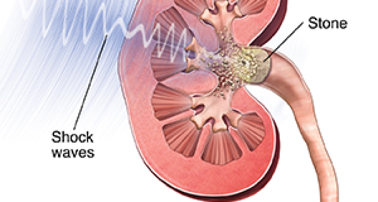 Lithotripsy Treatment in Hyderabad