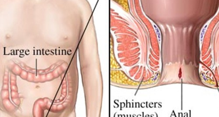 Anal Fissure Surgery