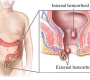 hemorrhoidectomy treatment