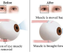 Strabismus Surgery