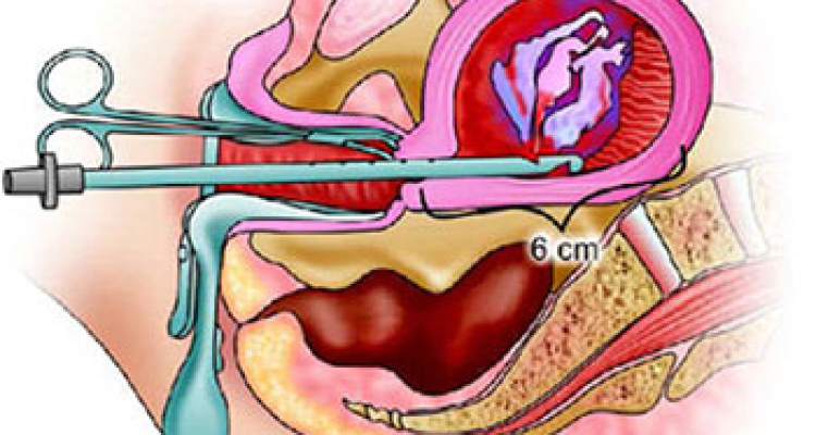 Medical Termination of Pregnancy (MTP) surgery in Hyderabad