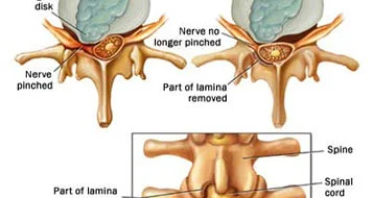 Laminectomy Surgery in Hyderabad